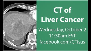 Facebook Live: CT of Liver Cancer