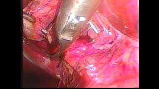 How I Do It: Laparoscopic Common Bile Duct Exploration