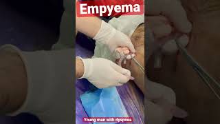 A huge #empyema more than 1.5L; #chest drainage