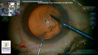 Verion guided Toric IOL Dr Sourabh Patwardhan Live Cataract surgery