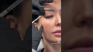 Botox eyebrowlift