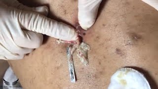 Cystic Acne Treatment - Blackhead Removal - Back Pimple Popping - Hidden Acne Spa Relaxing | #096