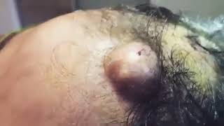 Sebaceous Cyst on the Head - Cisto Sebáceo