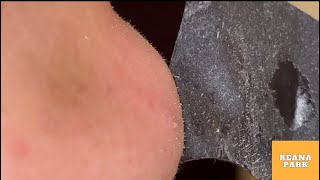 [アゴ角栓]ザラザラの角栓を毛穴パックで除去する　blackheads acne