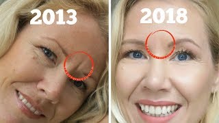 How to get rid of frown lines between eyes | BEAUTY OVER 40