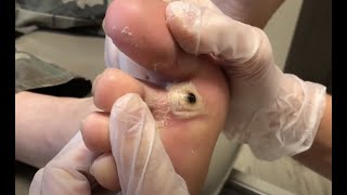 Foot Abscess Removal an explosion - Master Podology with Lexington Podiatry