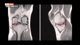 부산본병원 [KNN 건강365] 반월상연골판 손상 주의