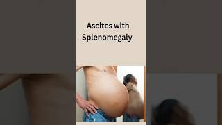 Ascites with Splenomegaly #medicine #ascites #splenomegaly