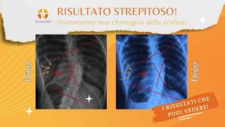 Clinica ScolioLife: Risultati sulla Scoliosi che Puoi Vedere (Caso 9)