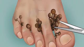 Remove fungal infection between toes | Foot care treatment animation | ASMR Treatment