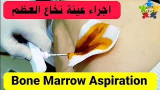 عينة نخاع العظم bone marrow biopsy جودة 4k