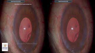 Dr Sourabh Patwardhan Live Cataract surgery. For training and consultation call 7028402375