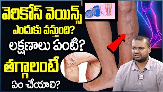 Varicose Veins Occurs & Treatment In Telugu | How to Get Rid Varicose Veins | Health Tips In Telugu