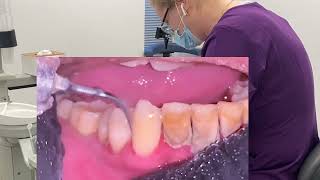 Dental cleaning / #duet teeth scaling