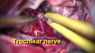 Hybrid endovascular and microsurgical treatment for large mesencephalic-cerebellar hemangioblastoma