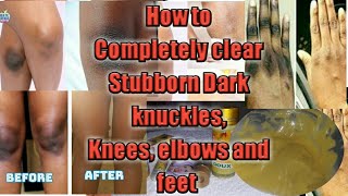 How to Promix a Fast Cream to Get Rid of Dark Knees and Elbows Within 14 Days.||BEAUTY BY BETTY ||