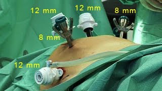 Robot-assisted radical prostatectomy; robot-assisted surgical removal of the prostate