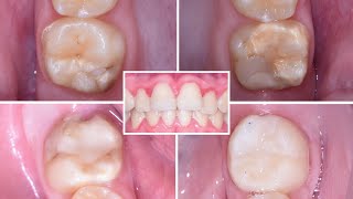 « Prise en charge prothétique des dents postérieures » par Léa Massé