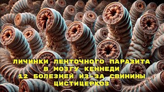 Гайд по Цистицеркозу. Личинки в Мозгу Кеннеди. 12 Болезней из-за Свинины