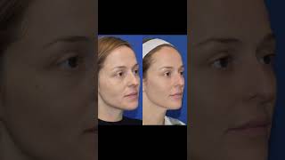 Sculptra Before & After