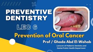 Dental Preventive 2 ; Lec 6 ; Prevention of Oral Cancer