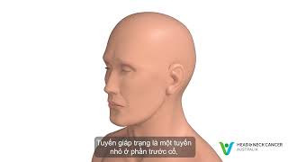 Vietnamese - What is Thyroid Cancer? Signs & Symptoms. Head and Neck Cancer