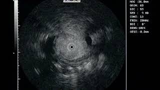 CBD benign stenosis IDUS