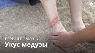 Учись первой помощи: жало медузы