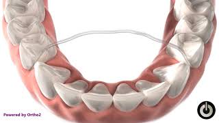 Fixed Lower Retainer Attached to Canines Only | Dental Braces | Temecula Valley, CA