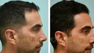 FUE Hair Transplant Results and Testimonial in Dallas, Texas with Dr. Lam