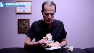 Cervical Foraminal Stenosis After Fusion by Dr. Tony Mork