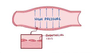 Hypertension | Osmosis