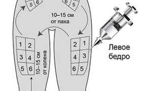 Как колоть укол внутримышечно. Укол в бедро. Укол в ногу.