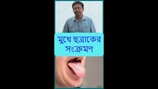 Mouth Yeast Infection | মুখে ছত্রাকের সংক্রমণ #shorts