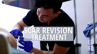 Quick In-Office Scar Treatment | Dr. Johnson C. Lee | Beverly Hills, CA