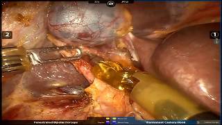 Robotic Surgery - Pancreatoduodenectomy (Whipple)