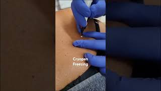 Cryo pen freezing method for skin lesions. #cryopen #cryotherapy #skintags #skincare #mole #shorts