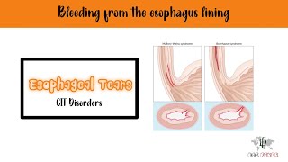 Esophageal Tears | Esophageal disorders 1.2 | Mallory Weiss syndrome | Boerhaave syndrome | GIT