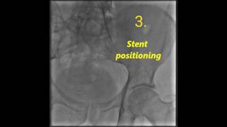 Stent implantation into the external iliac artery