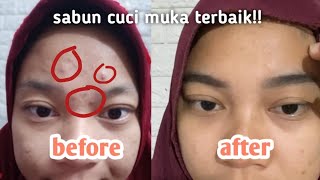 EMANG BENER ADA SABUN CUCI MUKA KHUSUS JERAWAT TANPA KETERGANTUNGAN?REVIEW JUJUR ERHA ACNEACT ACSBP