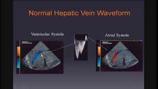 Doppler Ultrasound of the Liver and Portal Hypertension