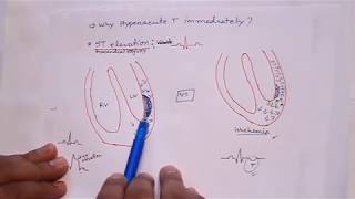 ECG 7 : Myocardial infraction ( ECG changes in MI and their mechanism)