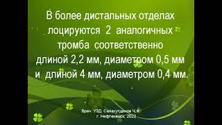 Подвижные тромбы на бляшке внутренней сонной артерии