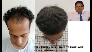 Amazing Results of Hair Transplant by Mumbai Doctor!