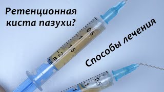 Ретенционная киста пазухи - что с ней делать? Закрытый синус-лифтинг, аспирация кисты, имплантация