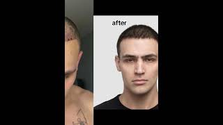 Hair Transplant in Turkey | Hair Transplant before after #hairtransplant