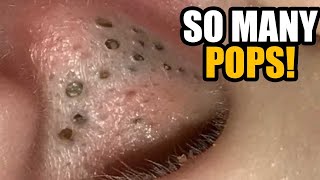 One Billion View Celebration!  Pimples, Ear Blackheads, Dilated Pores and Cyst Removal!