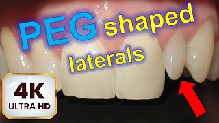 ❤️‍🔥 Dental IMPLANT, PEG shaped laterals and MIDLINE shifting timelapse. HOW BRACES WORK!