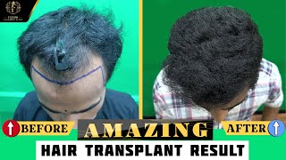 Amazing Hair Transplant Transformation: Before & After Pics | #hairtransplant