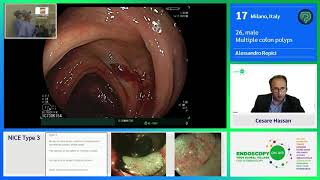 19. Милан. Множественные полипы толстой кишки. Алессандро Репичи